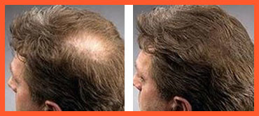 Лечение волос до и после Лечение волос до и после